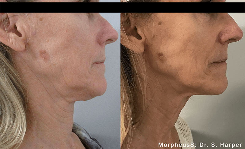 Woman's before and after Morpheus8, RF Micorneedling treatment at Viva Atlanta Wellness.