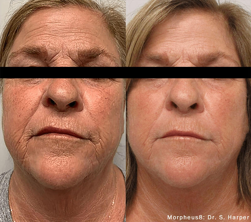 Woman's face showing before and after rejuvenation results from RF Microneedling, Morpheus8 at Viva Atlanta Wellness.