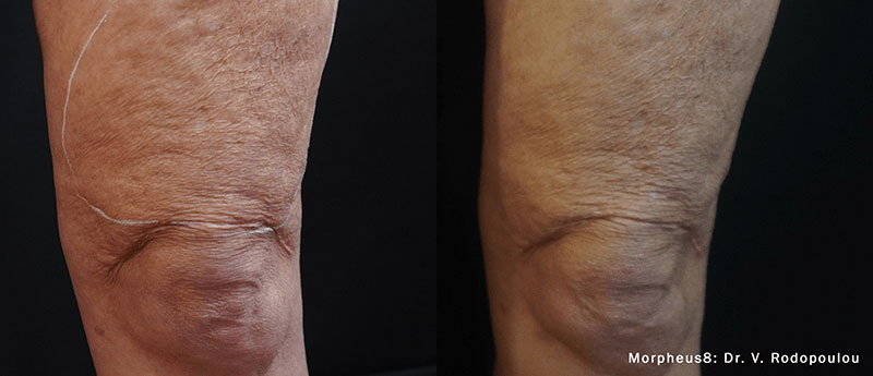 Thigh before and after RF Miconeedling with Morpheus8 treatment at Viva Atlanta.
