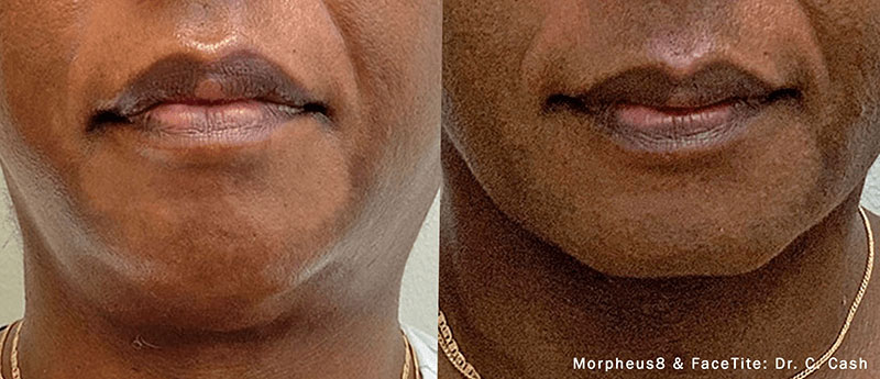 Chin area before and after results from RF Microneedling with Morpheus8 at Viva Atlanta.