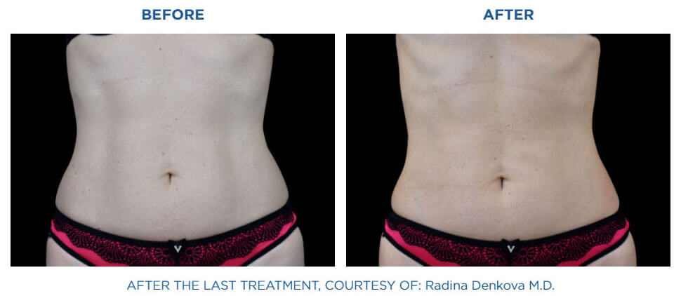 Abdomen showing before and after Emsculpt Neo at Viva Atlanta.