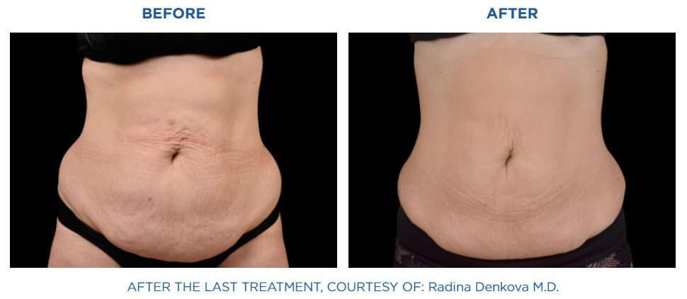 Viva Atlana's client's abdomen showing sculpted muscles before and after Emsculpt Neo Treatment.