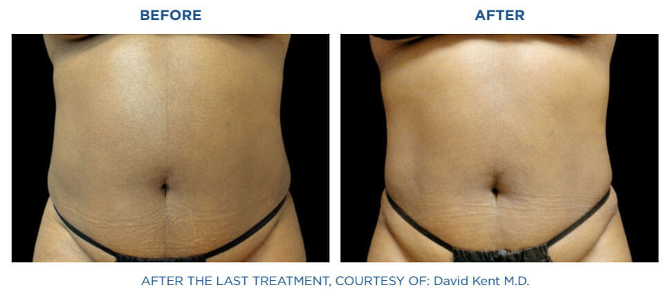 Before and after Emsculpt Neo results on the abdomen. Treatment at Viva Atlanta.