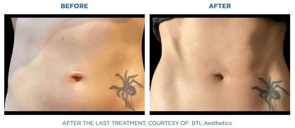 Toned abs before and after Emsculpt Neo at Viva Atlanta.